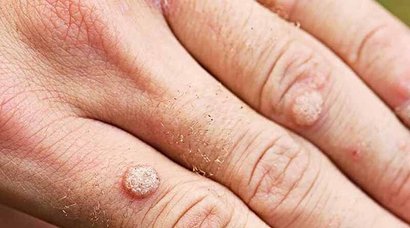 cách trị mụn cóc