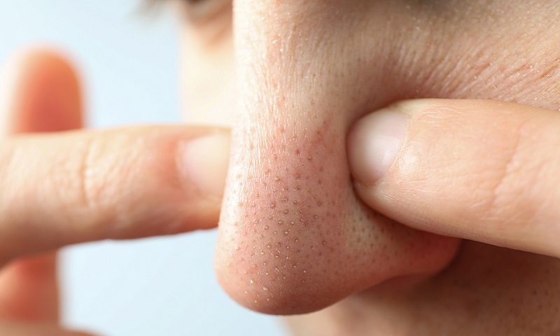 cách trị mụn đầu đen ở mũi